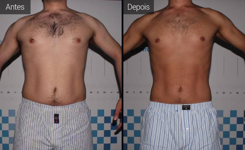 resultados - abdomen - flancos - vista frontal